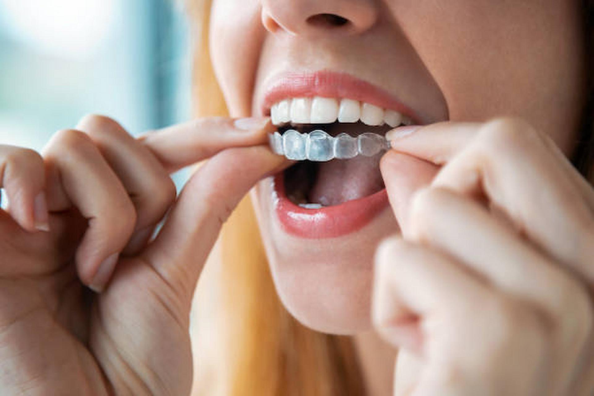 Why You Should Invest In Invisalign