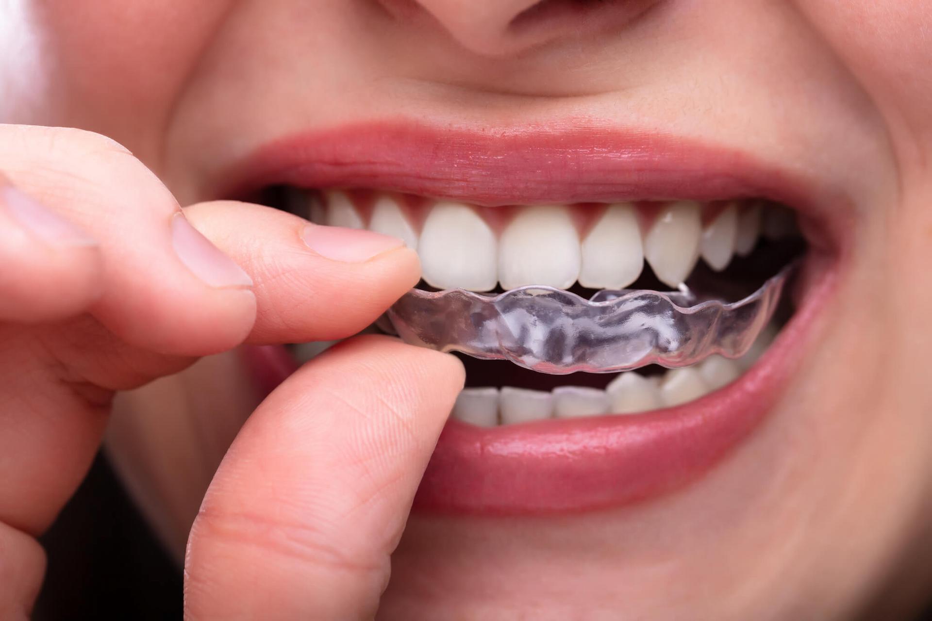 aligner treatments